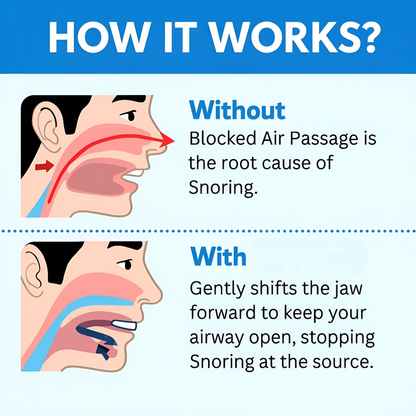 Averia® Anti Snoring Mouthpiece